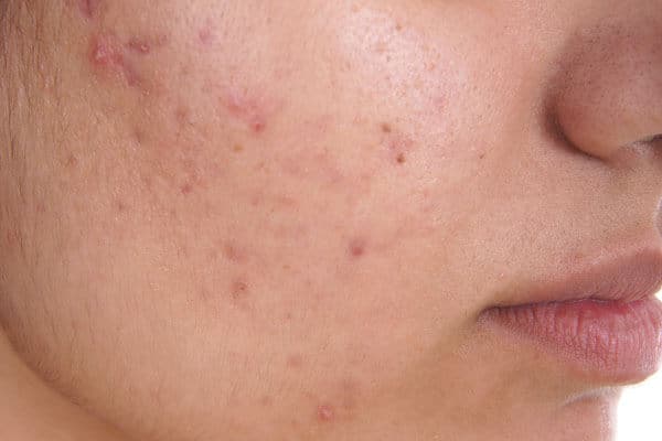 Acne Research: Acupuncture Treatment Outperforms Drug Therapy in Clearing Skin