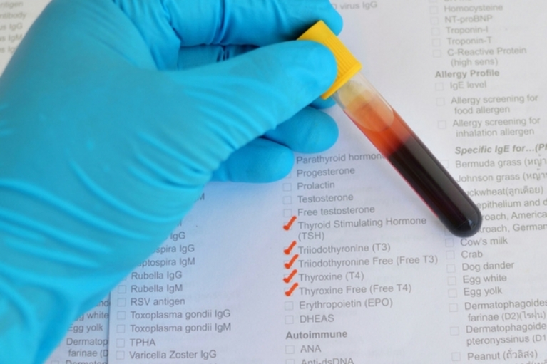 Hypothyroidism How to get Accurate Lab Testing When Taking Thyroid