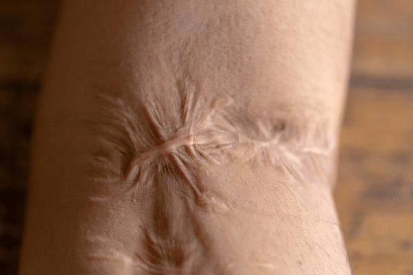 Scar Tissue: Why You Need Treatment