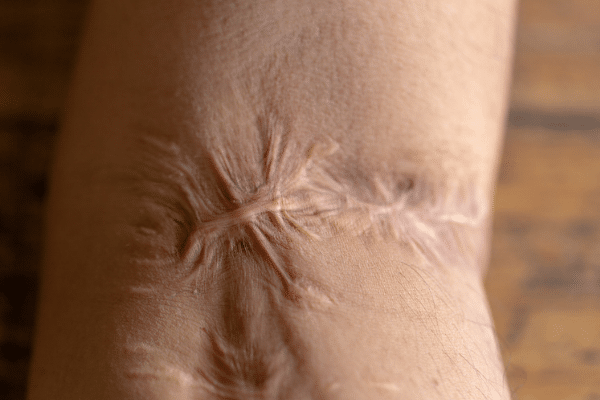 Scar Tissue: Why You Need Treatment • Oakville Naturopath, IV Therapy, Cosmetic Acupuncture, Bioidentical, Massage