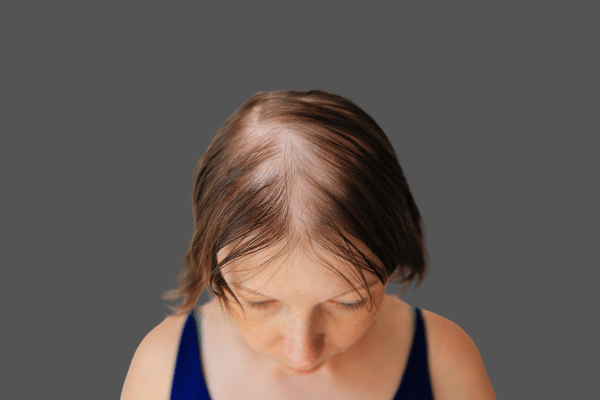 From Root to Remedy: Acupuncture’s Role in Hair Regrowth