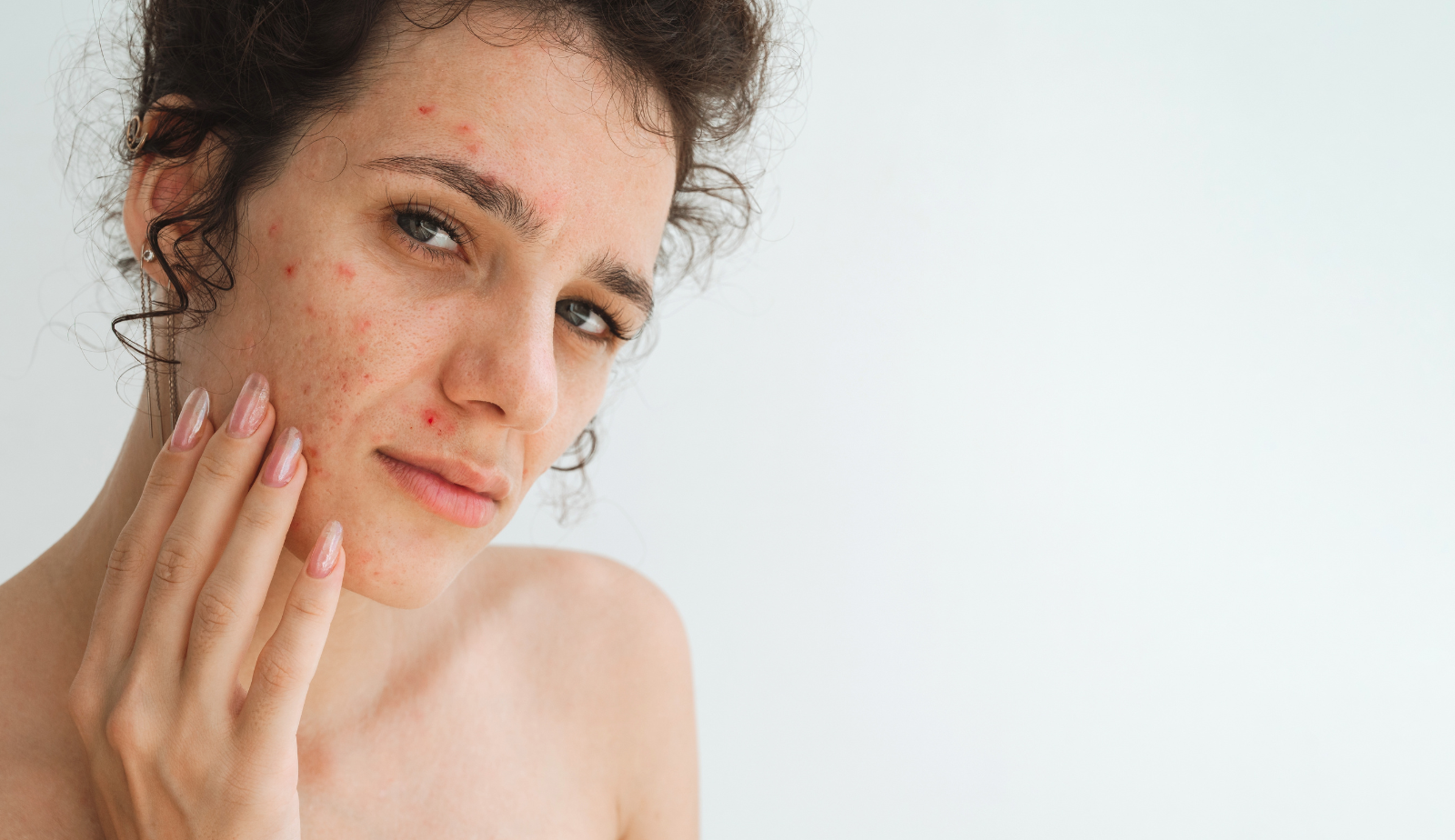 Acne: Getting on Track