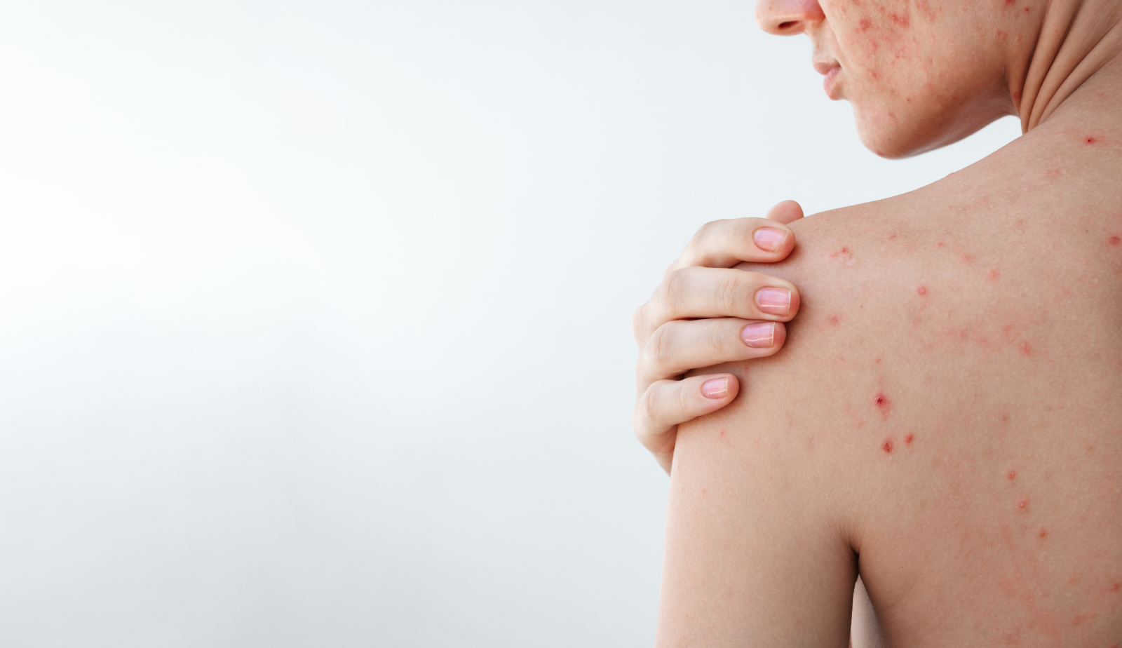 Acne: Why Your Skin Cares What’s for Dinner