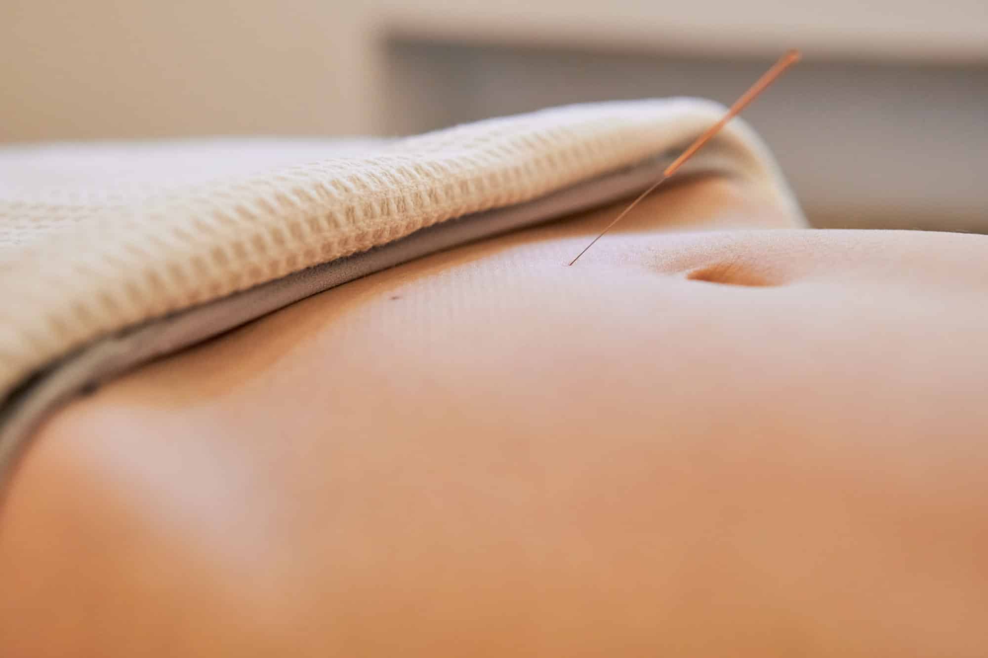 Better Oocyte, Better Endometrium: Acupuncture’s Fertility Edge